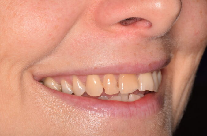 Before - Catherine Court Dentistry