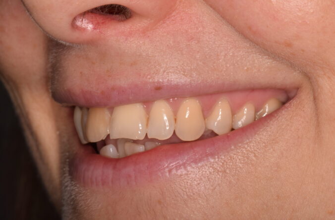 Before - Catherine Court Dentistry