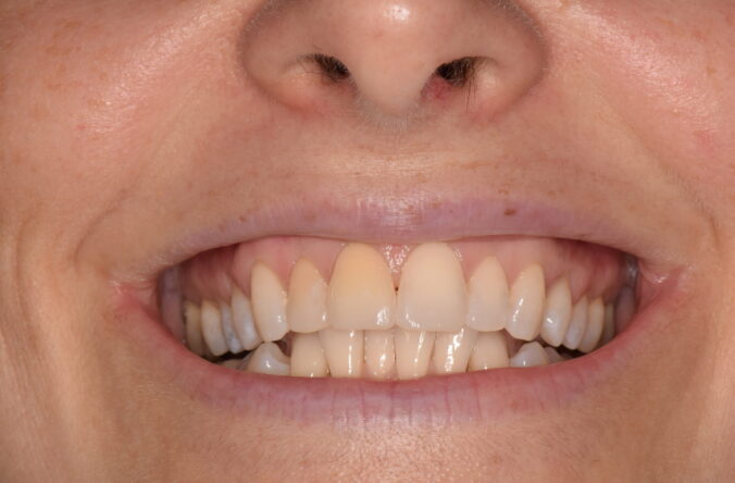 After - Catherine Court Dentistry
