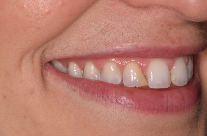 Before - Catherine Court Dentistry