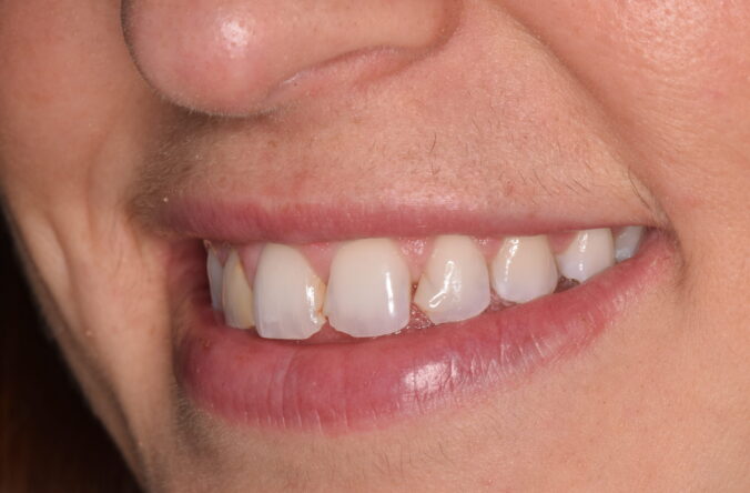 Before - Catherine Court Dentistry