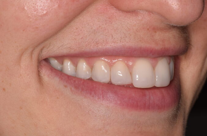 After - Catherine Court Dentistry